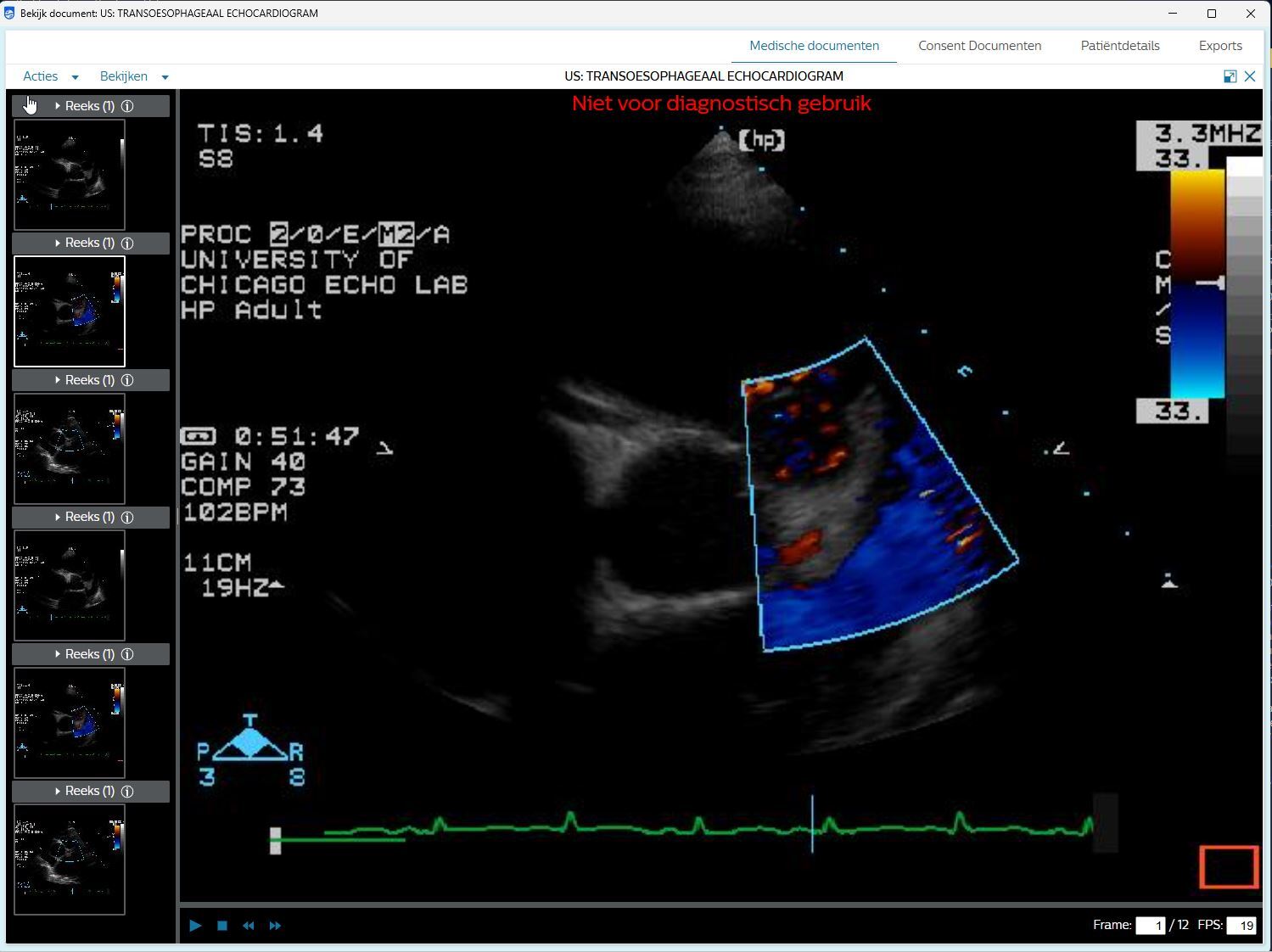 Cardiology System Integration at St Antonius Ziekenhuis